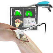 Augmented Reality Navigation (ARVIS) Total Knee Replacement