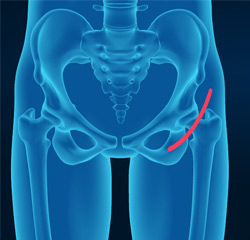 Outpatient Hip Replacement