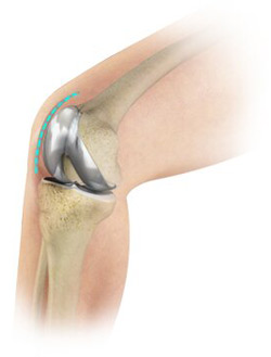 Outpatient Total Knee Replacement