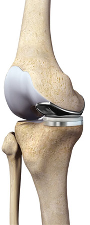 Partial Medial Knee Replacement