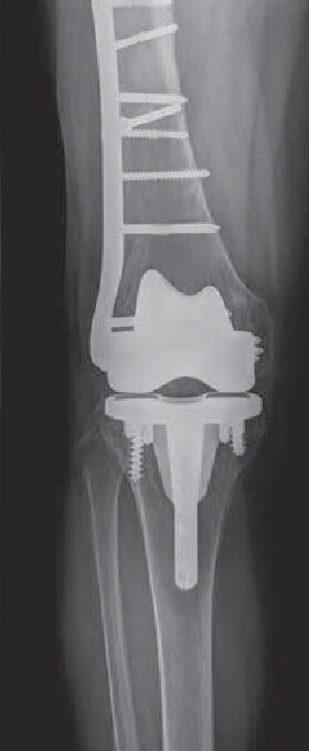 Periprosthetic Knee Fractures